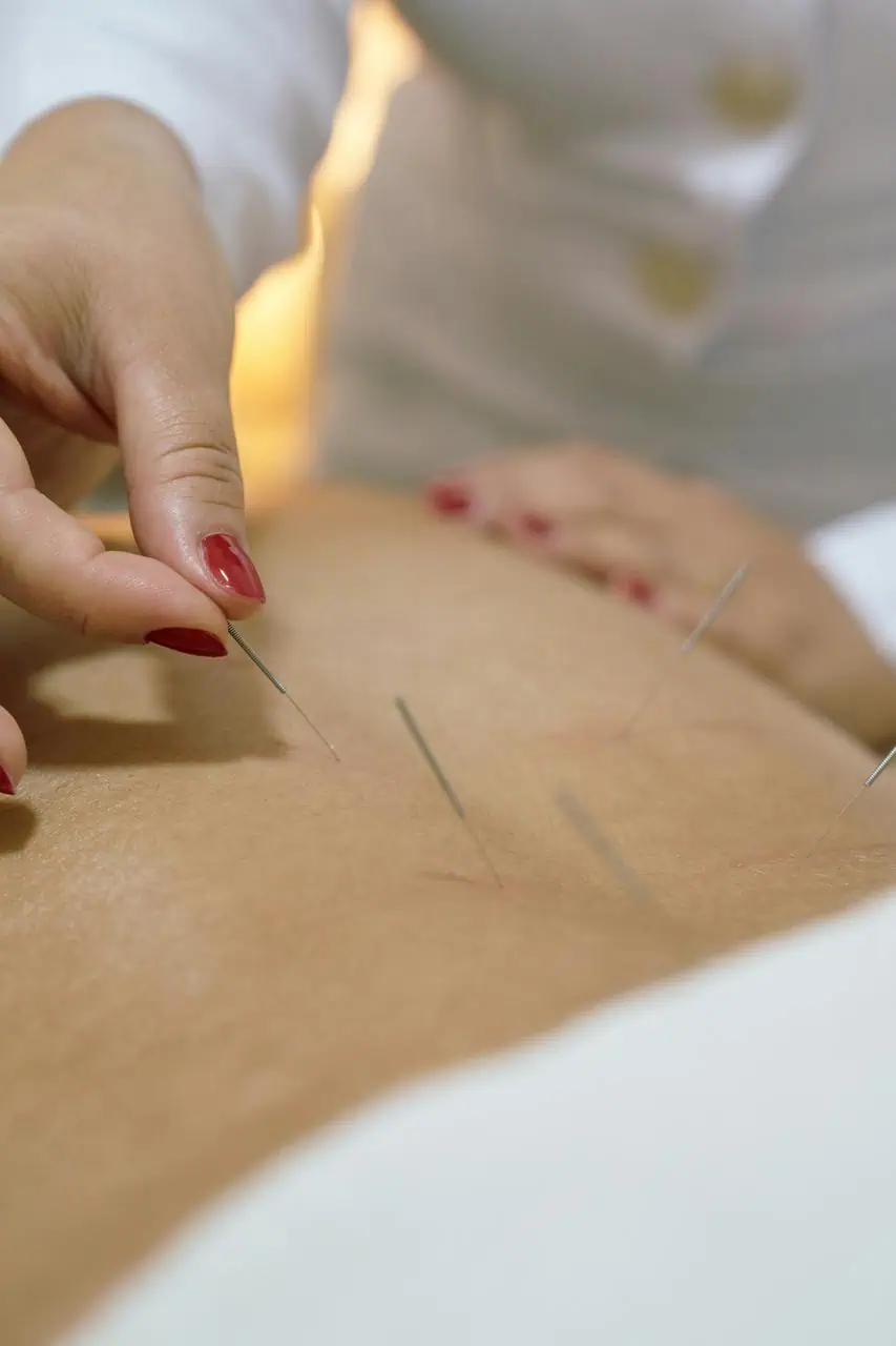 Acupuncturist inserting sterile needles into patient back during traditional therapy session